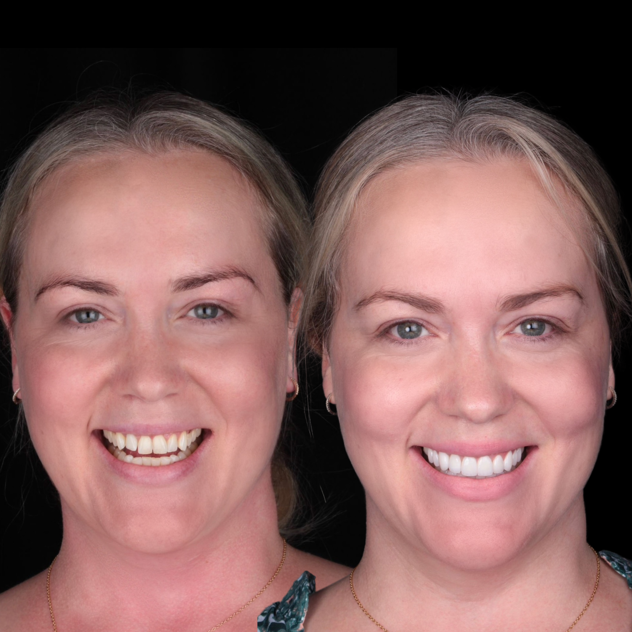 before & after dental crowns treatment