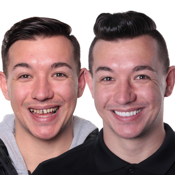 before & after porcelain veneers treatment