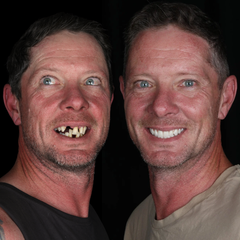 before and after dental implants